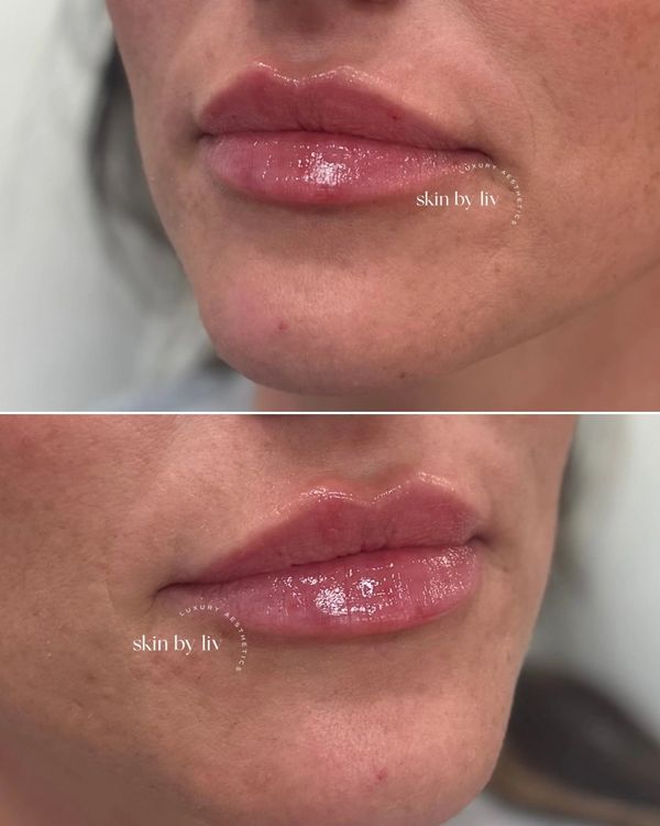 Lip filler before and after, woodbury med spa