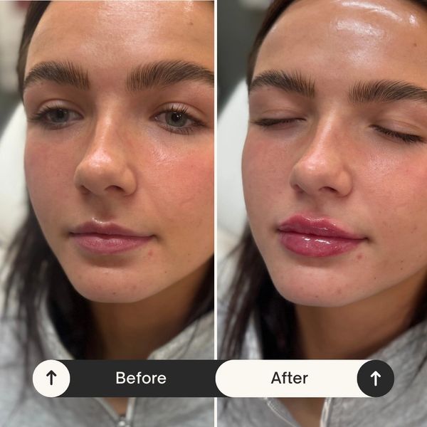Lip filler before and after, woodbury med spa