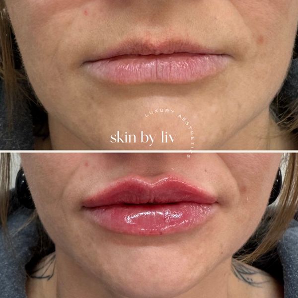 lip filler before and after Woodbury med spa, lip filler specials.