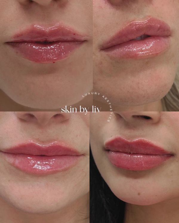 Lip filler before and after, woodbury med spa