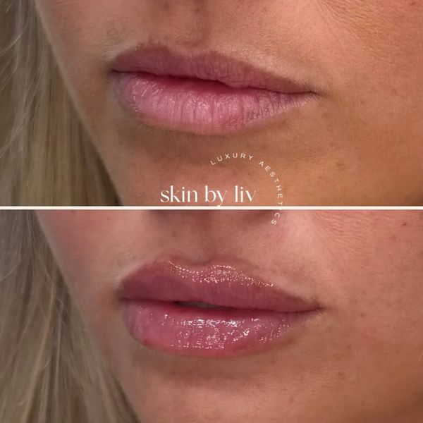 Before and after lip filler enhancement showing natural lips. woodbury med spa
