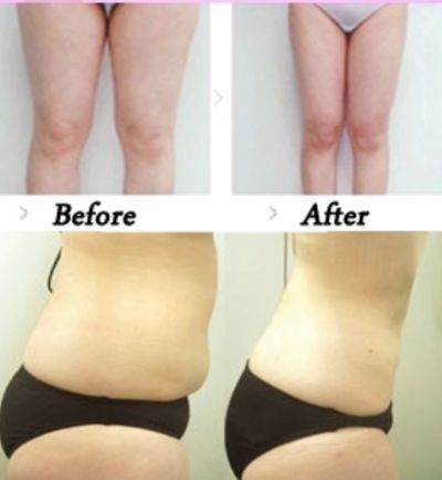 Before/after cellulite reduction