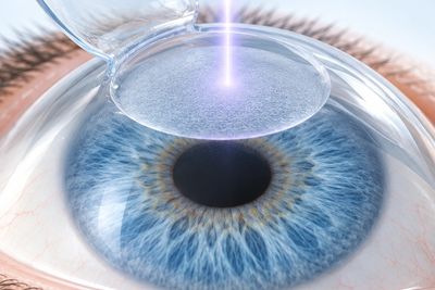 LASIK