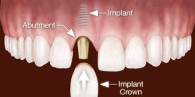 Craig Droskin DDS Dental Implants