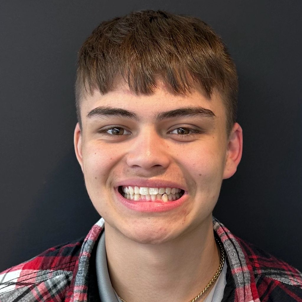 Before Clear Aligner Therapy by Dr. Droskin