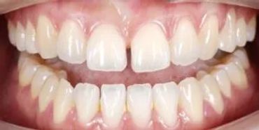 Clear Aligners close spaces