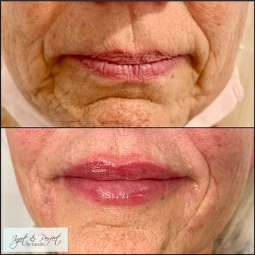 Lip Filler before and after Woburn, MA