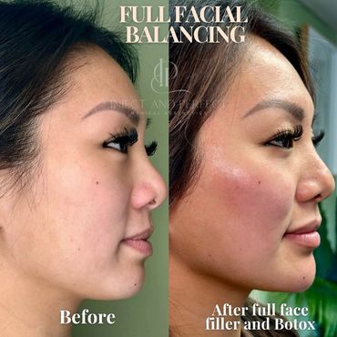 Botox and dermal filler treatment Woburn, MA