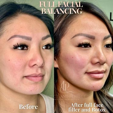 Before and after Botox soften lines Plaistow, NH