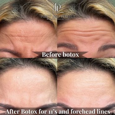 Before and after BOTOX soften forehead lines Woburn, MA