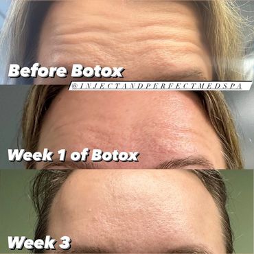 Botox injection for women in woburn, ma