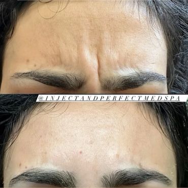 Botox Injections Plaistow, NH