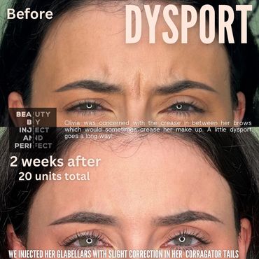 dysport filler woman woburn, ma