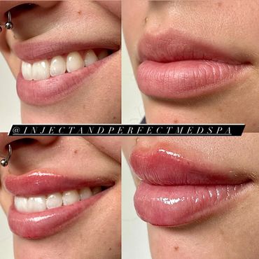 lip filler lip flip in woburn, ma