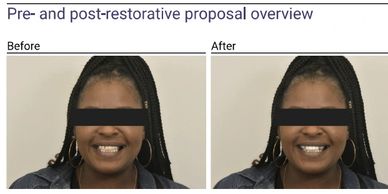 Before and after photos of a woman showing restorative dental work.
