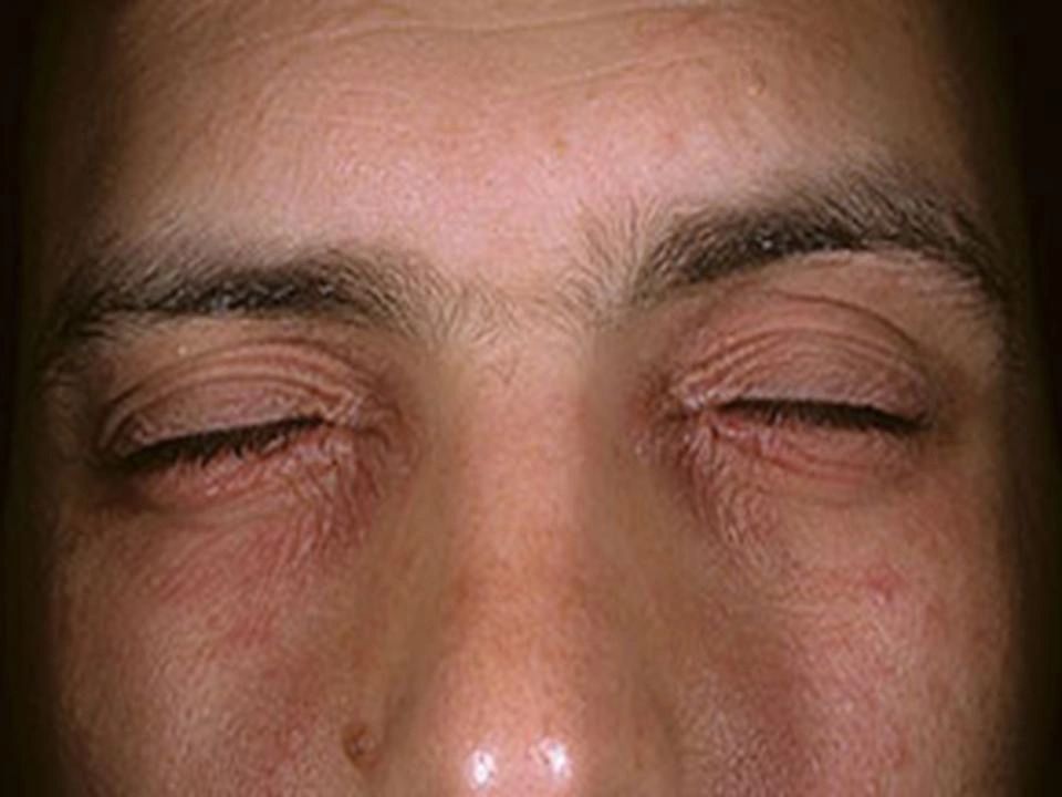 Mold Eye Infection