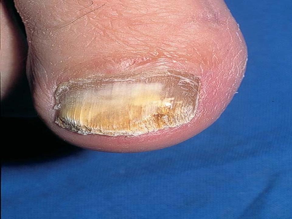 Common Fungal Nail Infection