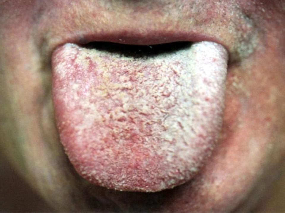Oral Mold Growth Fuzzy Tongue