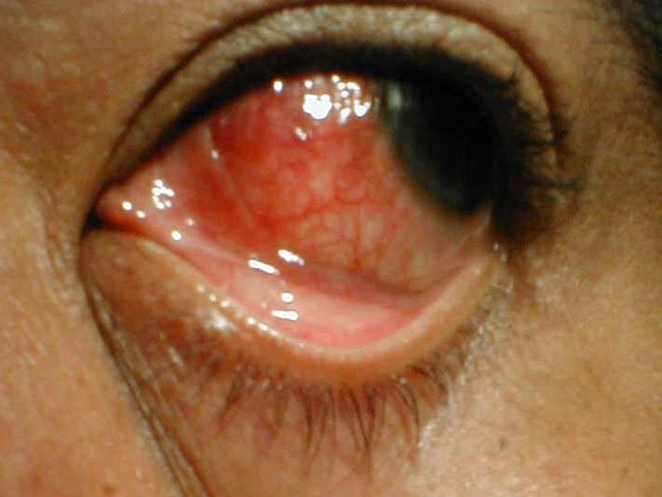 Ocular Fungal Infection 