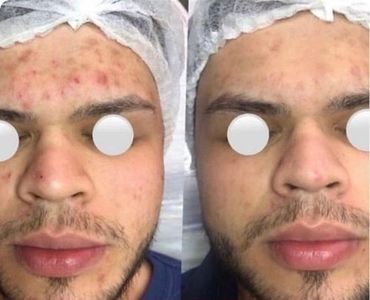 Laser Acan treatment