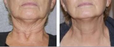 Before and after neck skin tightening treatment on an elderly woman.