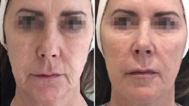 Before and after facial treatment showing reduced wrinkles and smoother skin.