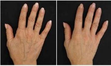Comparison of a hand before and after skin treatment.