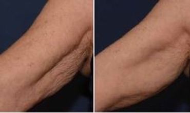 Before and after images showing reduced arm wrinkles and smoother skin.