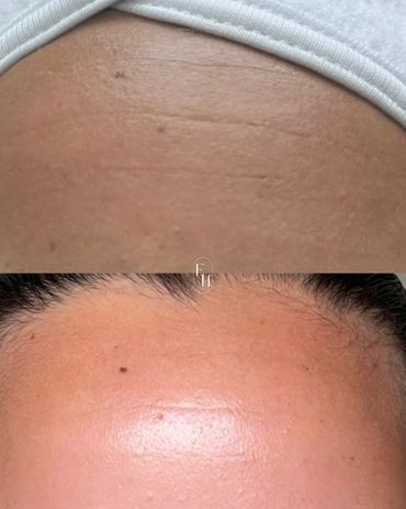 Close-up of forehead before and after one session of fibroblast treatment.