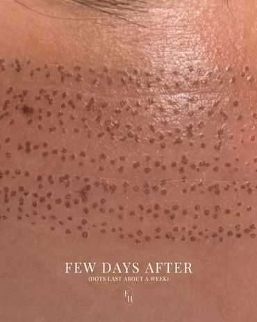 Dots on skin from fibroblast treatment, showing mild scabbing a few days later.