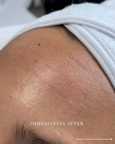 Treatment results immediately after fibroblast therapy with visible tiny white dots.