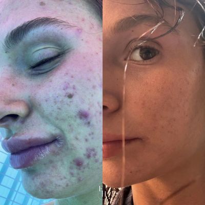 Hallandale Brickell Miami, FL Spa, Facial, laser acne removal brightening, sagging skin