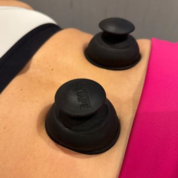 cupping physio east devon