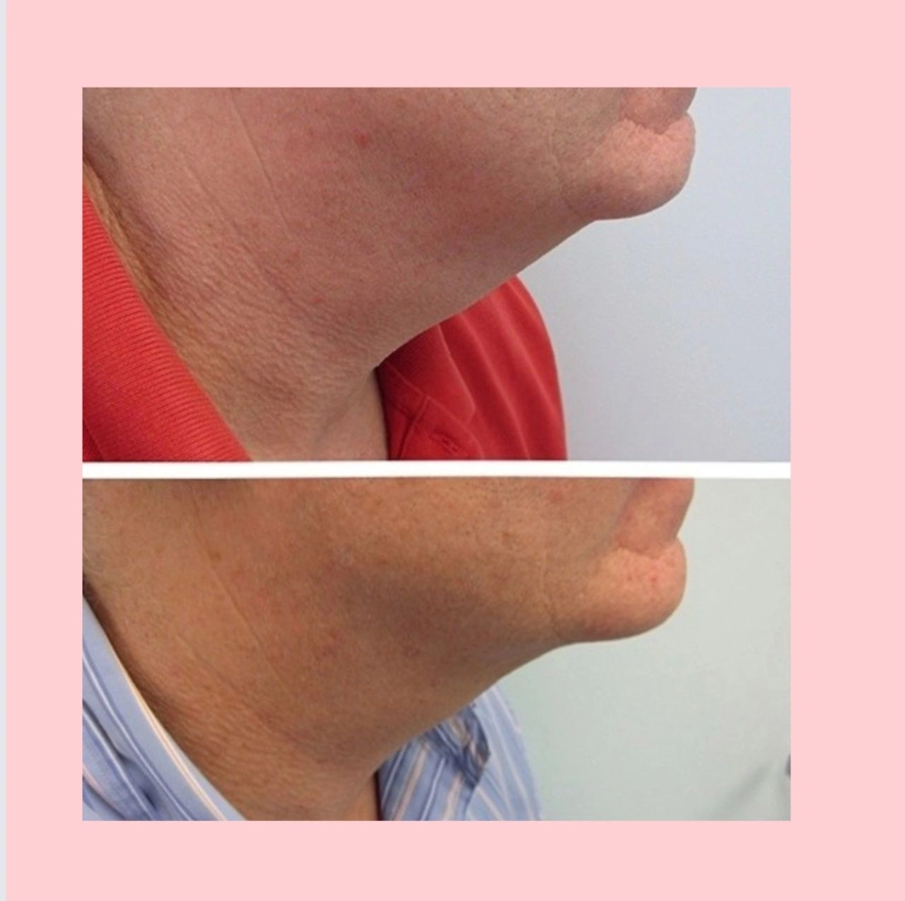 Doble chin reduction