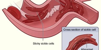 Medical image of sickle cell blocking blood flow.
Trump, sickle cell, blacks
