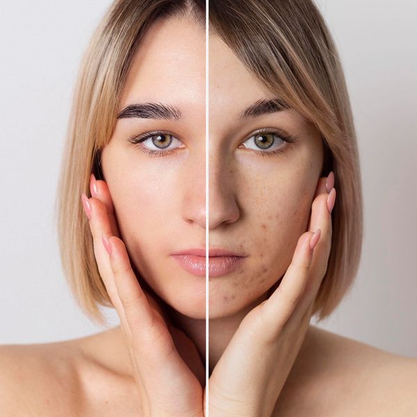 Antes y después de mujer que se realizó tratamiento para eliminar secuelas de acné.