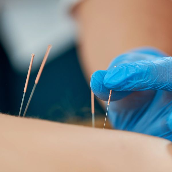 Acupuncture now available at Ocean Bay Wellness