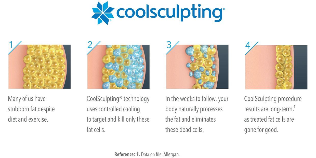 Visual diagram showing how the Coolsculpting procedure targets fat cells.
