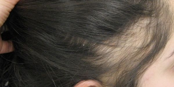 Side view of women's head showing hair loss