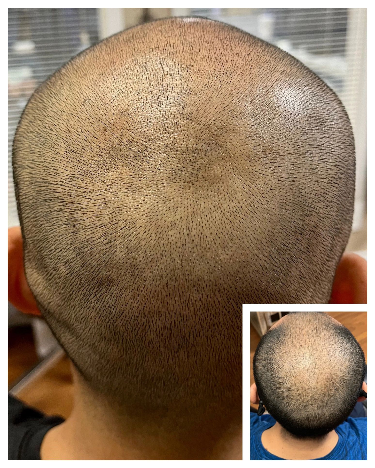 Scalp Micropigmentation in Chico - North State Scalp Center