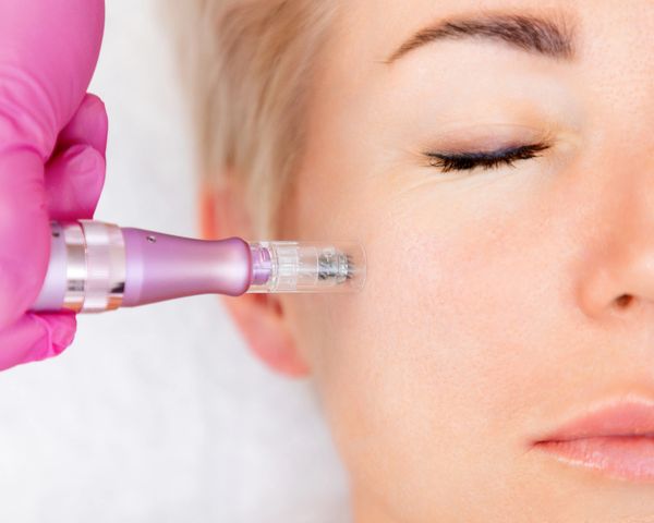 Woman receiving microneedling treatment