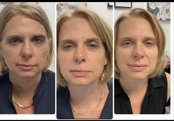 Before and after photo of a woman's face. She received an IPL Skin treatment.