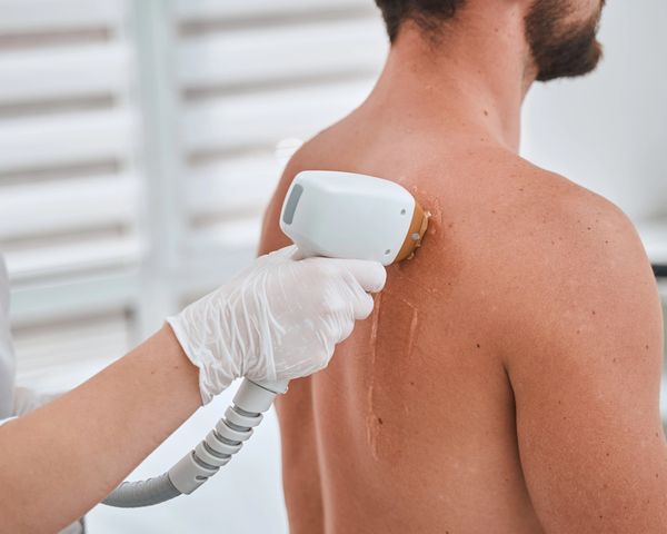 Man receiving laser hair removal on back.