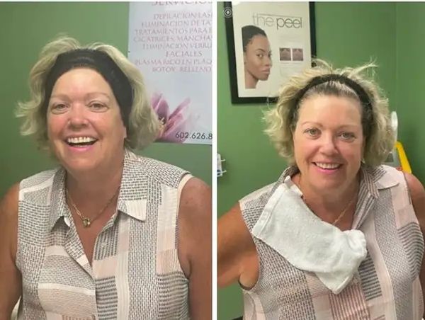 Woman's Face Before and After Receiving IPL Skin Rejuvenation Service.