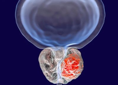 Benign Prostat Hiperplazisi