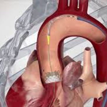 Valvular Heart Disease