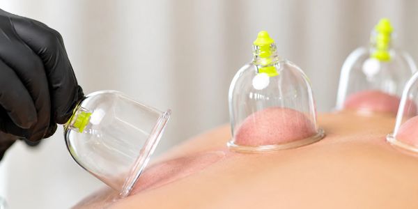 Cupping therapy with glass cups on back skin.
