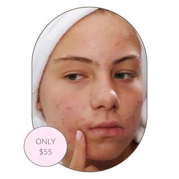 teenager acne facial treatment at spa