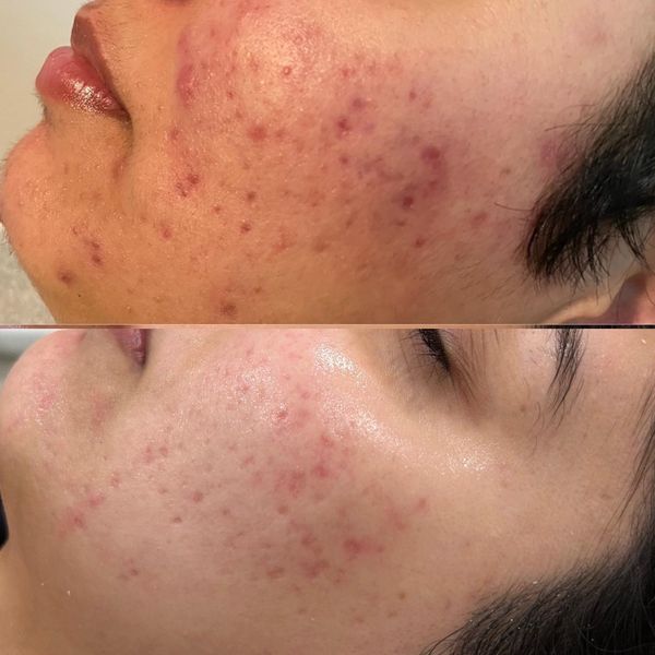 microneedling before and after. minimized pores results jadore laser & spa white rock surrey