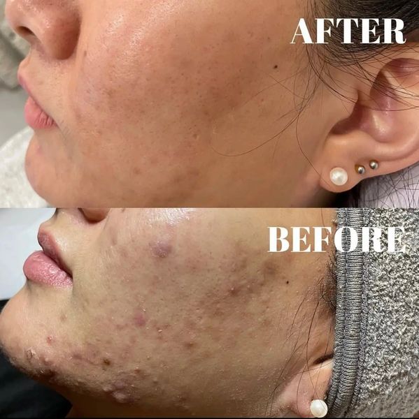 before and after skin treatments jadore laser and spa